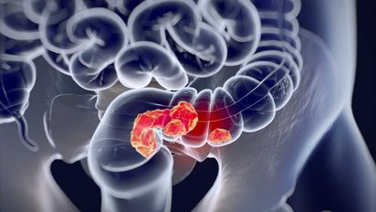 Importante para la Generación Z: Avance contra el cáncer de colon en jóvenes