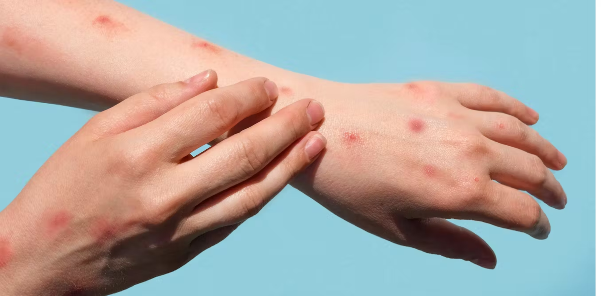 La primera vacuna contra la viruela del mono ya está aprobada para adolescentes. La primera vacuna contra la viruela del mono ya está aprobada para adolescentes.