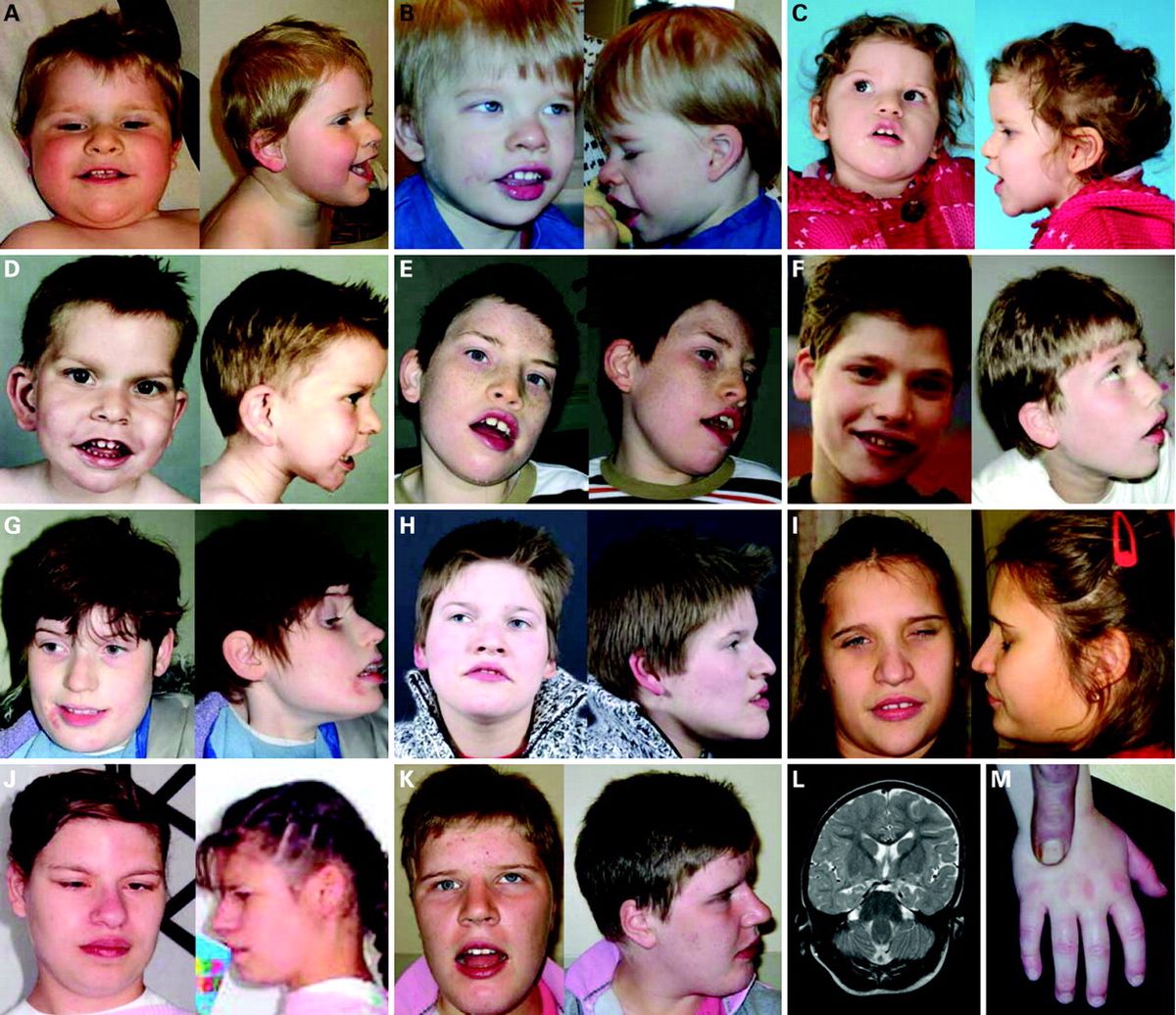 ¿Una enfermedad rara? Síndrome de PittHopkins