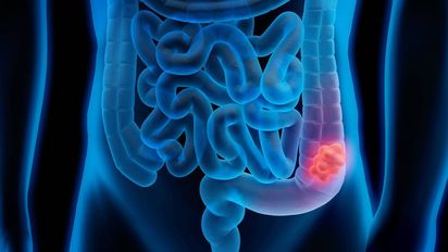 Este alimento cotidiano te pone en riesgo de cáncer de colon