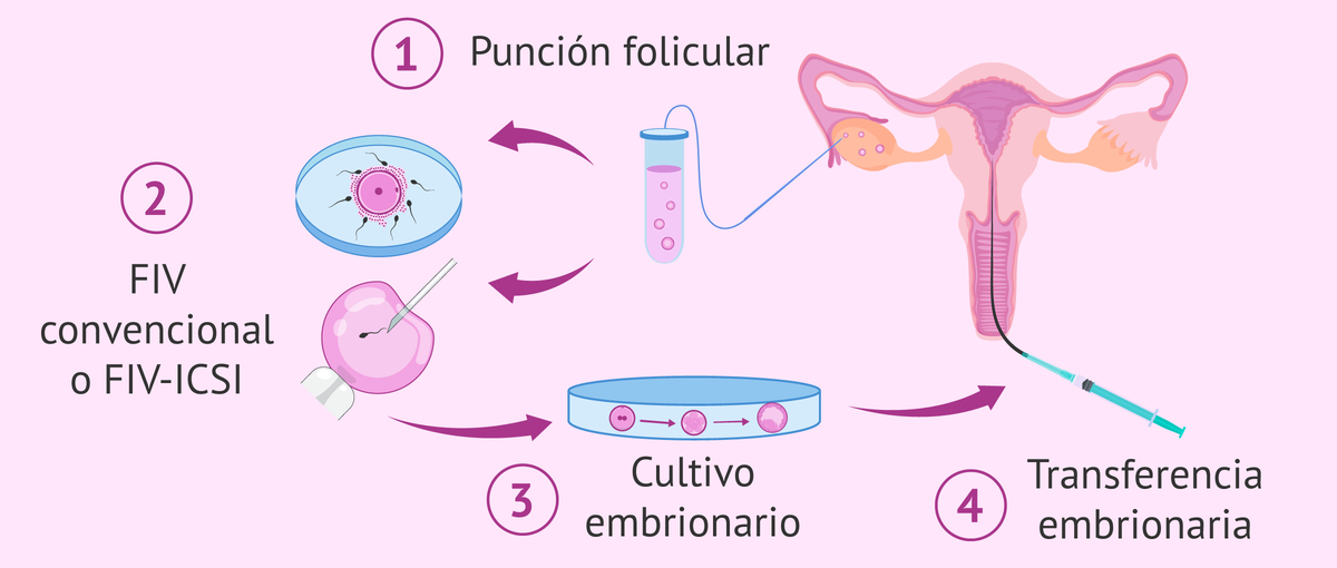 La fertilización in vitro hoy es uno de los tratamientos médicos más comunes para la infertilidad. A pesar de recibir cuestionamientos éticos y morales, en los últimos años nacieron más de 8 millones de bebés gracias a él. La fertilización in vitro hoy es uno de los tratamientos médicos más comunes para la infertilidad. A pesar de recibir cuestionamientos éticos y morales, en los últimos años nacieron más de 8 millones de bebés gracias a él.