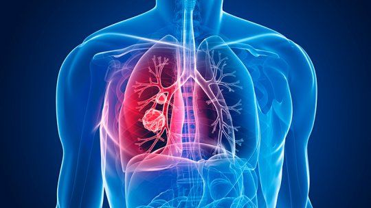 Síntomas de cáncer de pulmón en no fumadores imposibles de ignorar. Síntomas de cáncer de pulmón en no fumadores imposibles de ignorar.