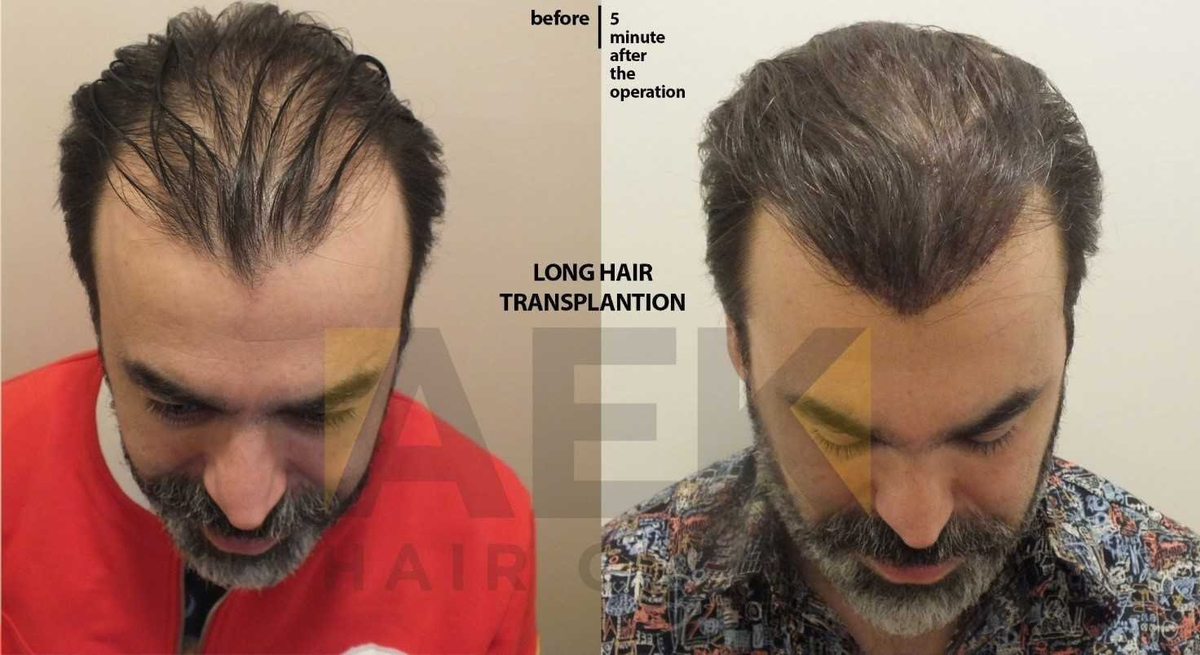 Resultados 5 minutos después de la operación.