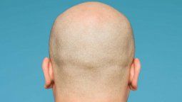 La alopecia tiene tratamiento y una dermatóloga lo explica.