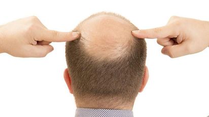 Este alimento empeora la caída del cabello, dice dietista