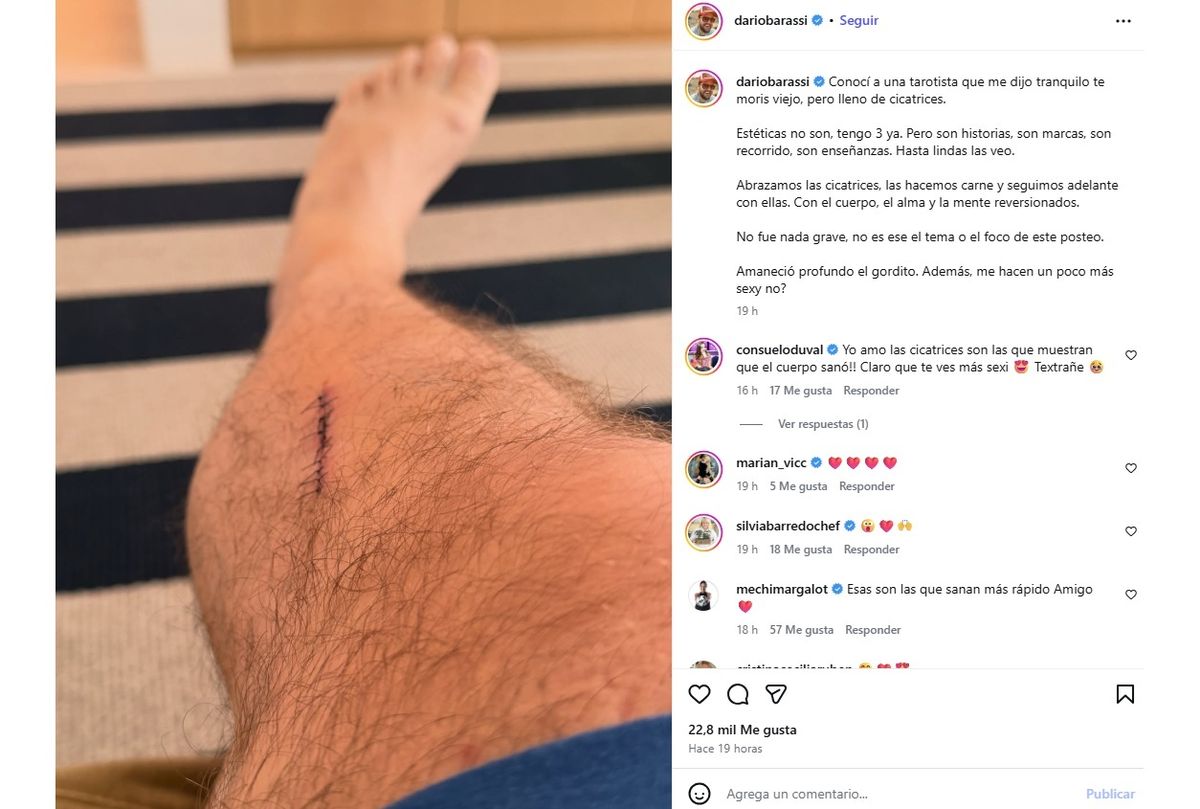 Darío Barassi mostró su pierna luego de sufrir el accidente. Darío Barassi mostró su pierna luego de sufrir el accidente.