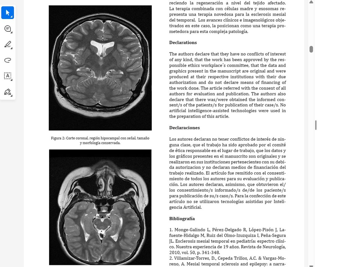 "La pérdida neuronal, es particularmente significativa a nivel del giro dentado y en las regiones área de Sommer y del hipocampo, con predilección por las células piramidales." "La pérdida neuronal, es particularmente significativa a nivel del giro dentado y en las regiones área de Sommer y del hipocampo, con predilección por las células piramidales."
