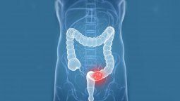 Esta bebida conocida se relaciona con cáncer, incluyendo cáncer de colon.