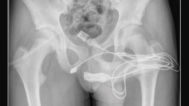 Insertó un cable USB en su miembro y terminó en el hospital