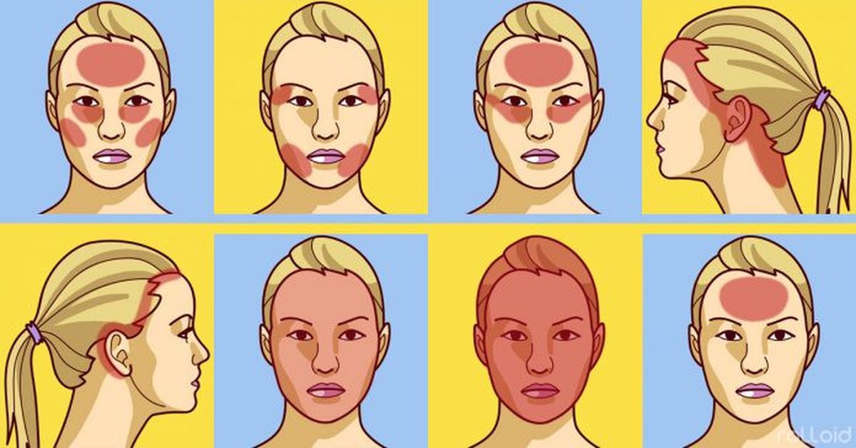 Zonas de la cabeza donde la migraña puede sentirse, dependiendo de las circunstancias por las que se origine