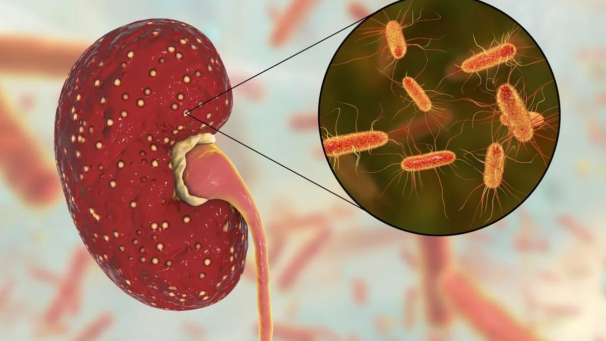 Ampliación de la bacteria del E.Coli en un riñón, causante del Síndrome Urémico Hemolítico
