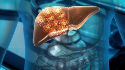 Cáncer de hígado y enfermedad hepática: Evite esta bebida.