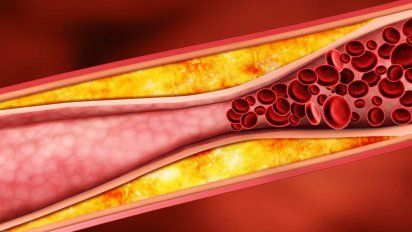 Esta fruta reduce colesterol y evita que tape las arterias