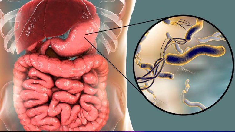 Científicos revelan que 3 de cada 4 casos de cáncer de estómago podrían evitarse