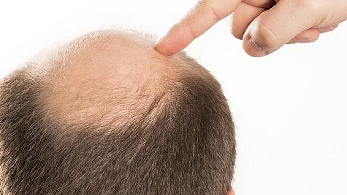 Estos son los nutrientes y vitaminas que necesita tu cuerpo para evitar perder pelo.