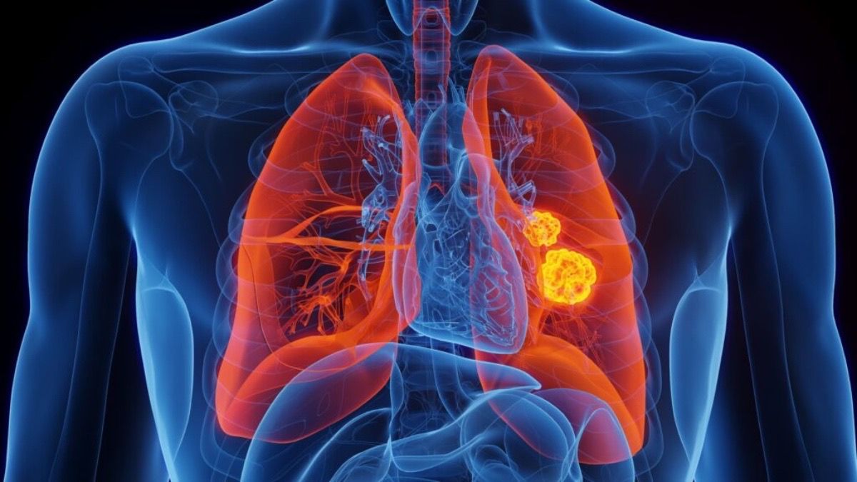 Cáncer de pulmón: el estudio que revela cómo se encuentra la enfermedad en Argentina.