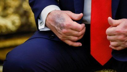 Moretón en la mano de Trump: ¿Por qué el líder MAGA esconde hematomas?