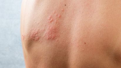 5 cosas que muchos desconocen sobre el herpes zóster