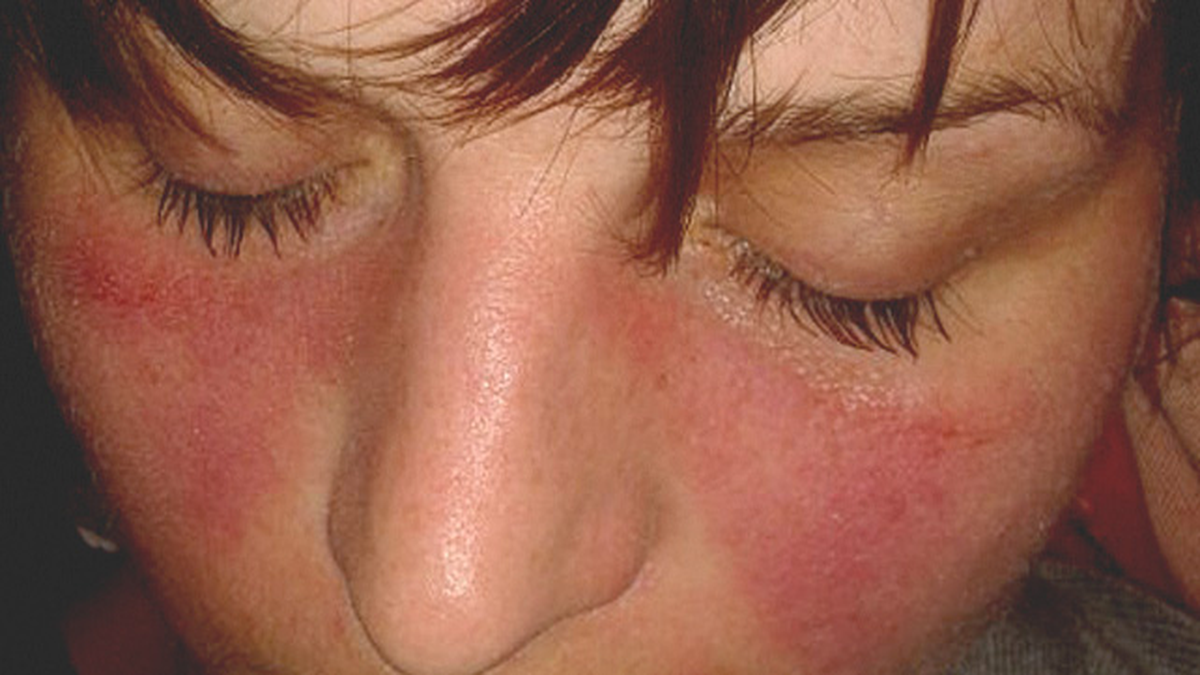 El lupus es una enfermedad rara que presenta diversos s&iacute;ntomas, siendo el m&aacute;s identificable los brotes en la piel y en la cara que dan apariencia de "rostro de mariposa".