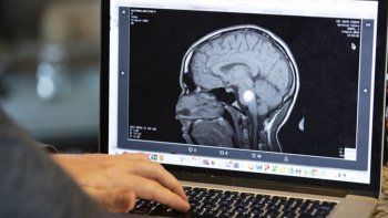 El delicado procedimiento de extracción de líquido cefalorraquídeo podría plantear desafíos para su uso en personas, pero los hallazgos mejoran la comprensión del envejecimiento en el cerebro y son prometedores para futuras vías de investigación. El delicado procedimiento de extracción de líquido cefalorraquídeo podría plantear desafíos para su uso en personas, pero los hallazgos mejoran la comprensión del envejecimiento en el cerebro y son prometedores para futuras vías de investigación.